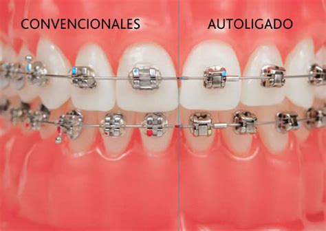 diferencia entre brackets metalicos y autoligados|autoligado vs brackets convencionales.